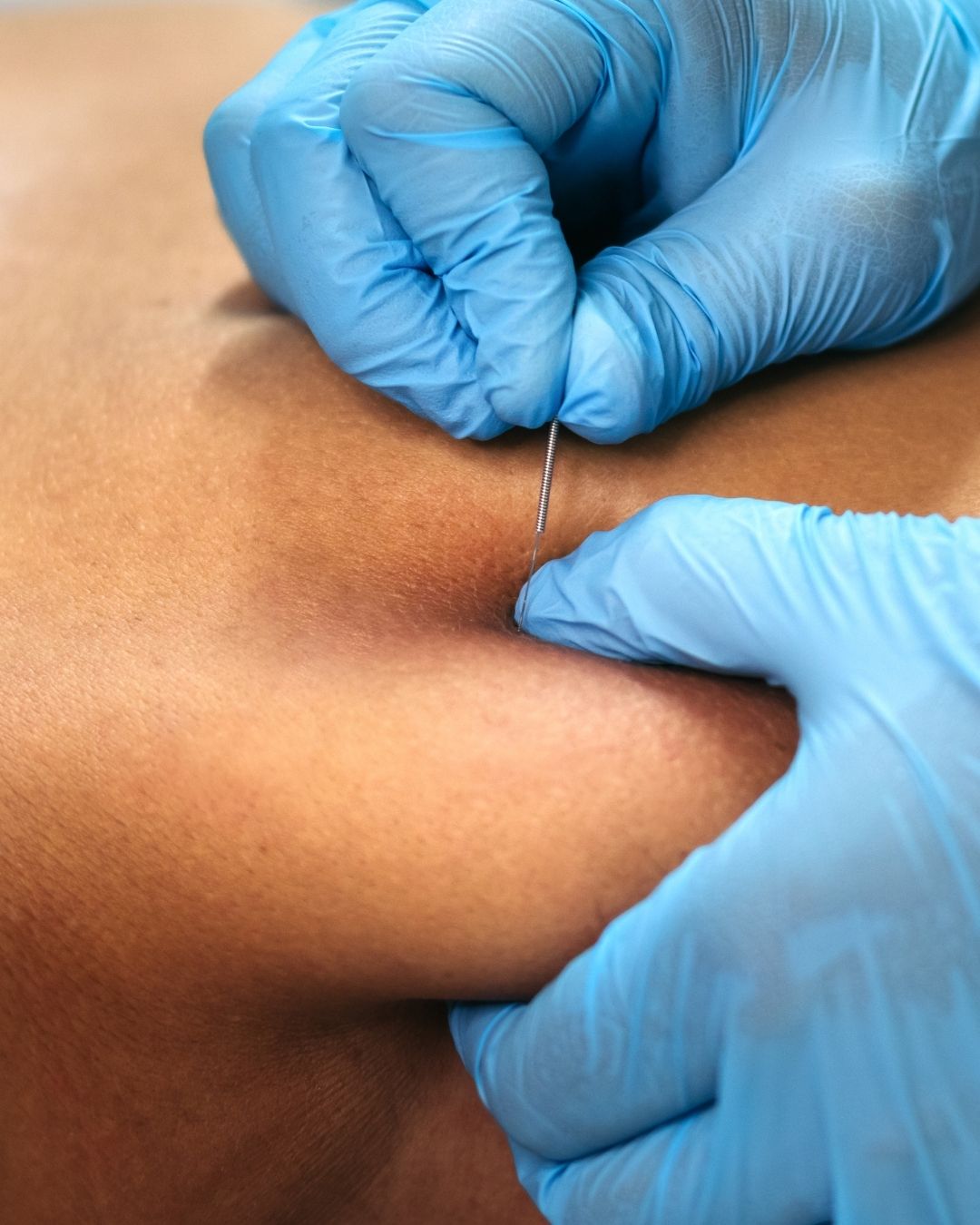 Dry Needling