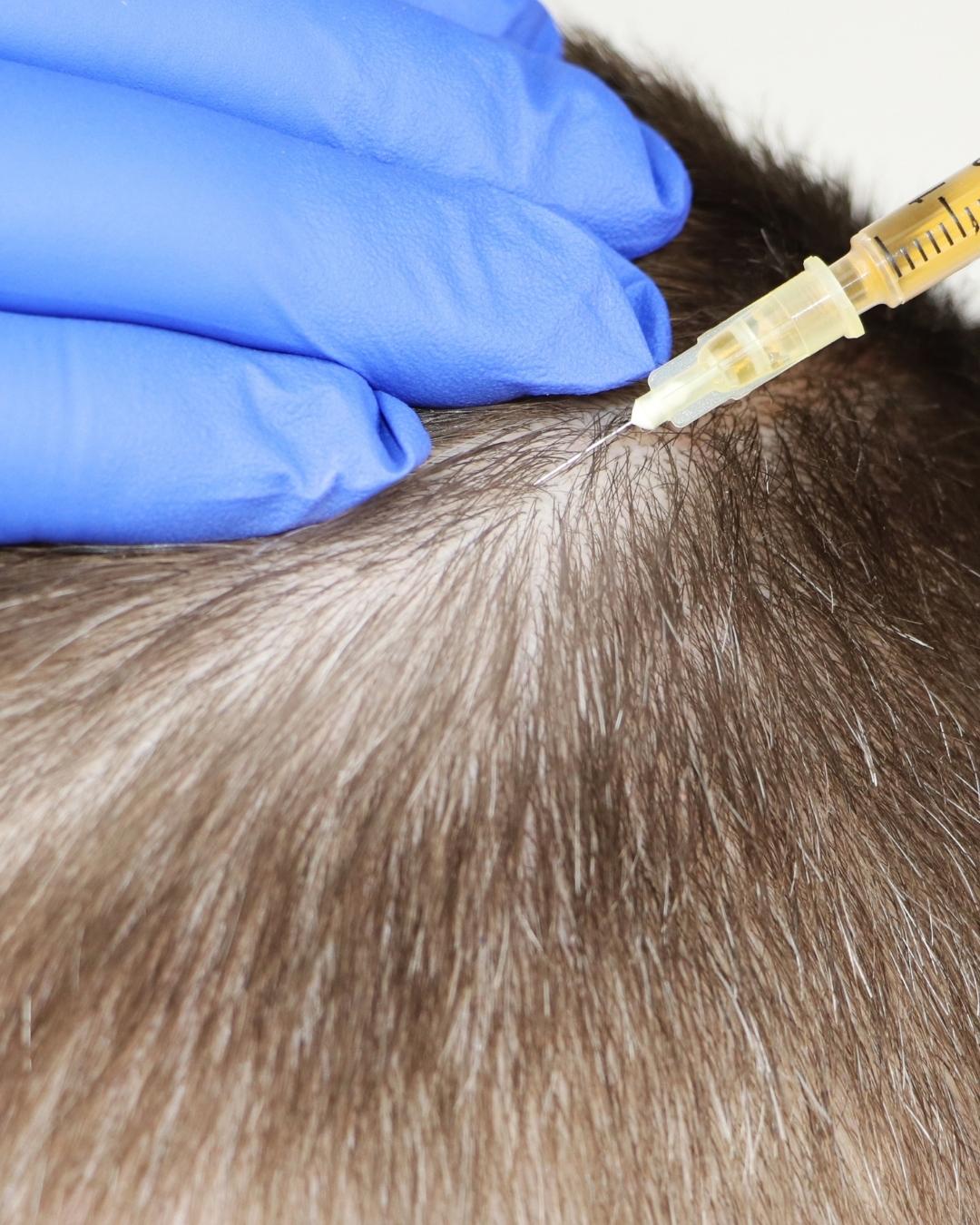 PRP Hair Care