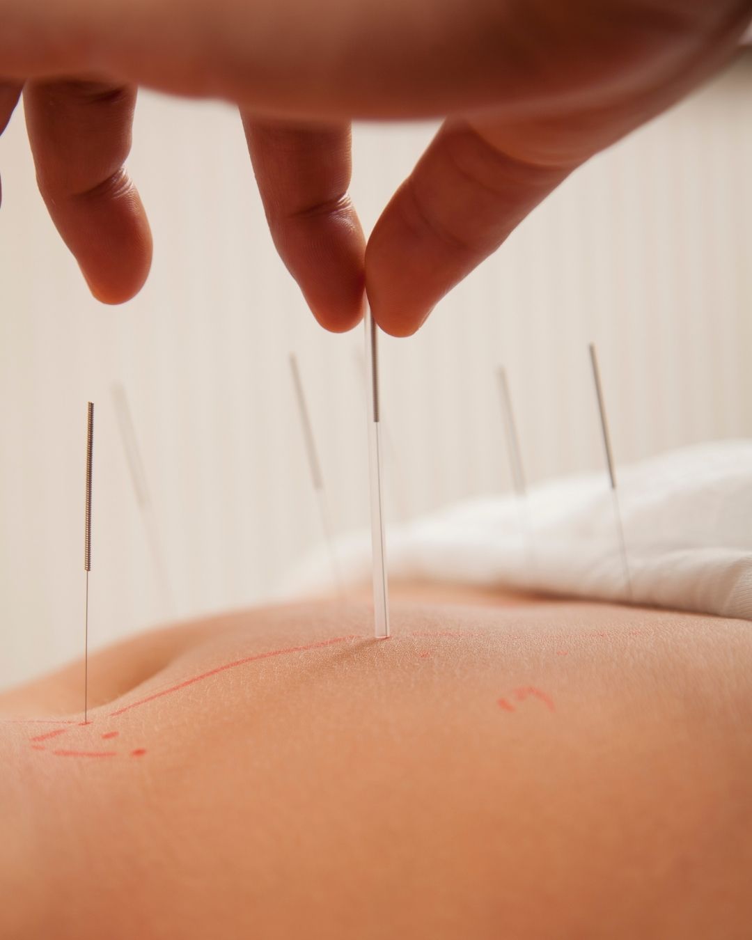 Medical Acupuncture