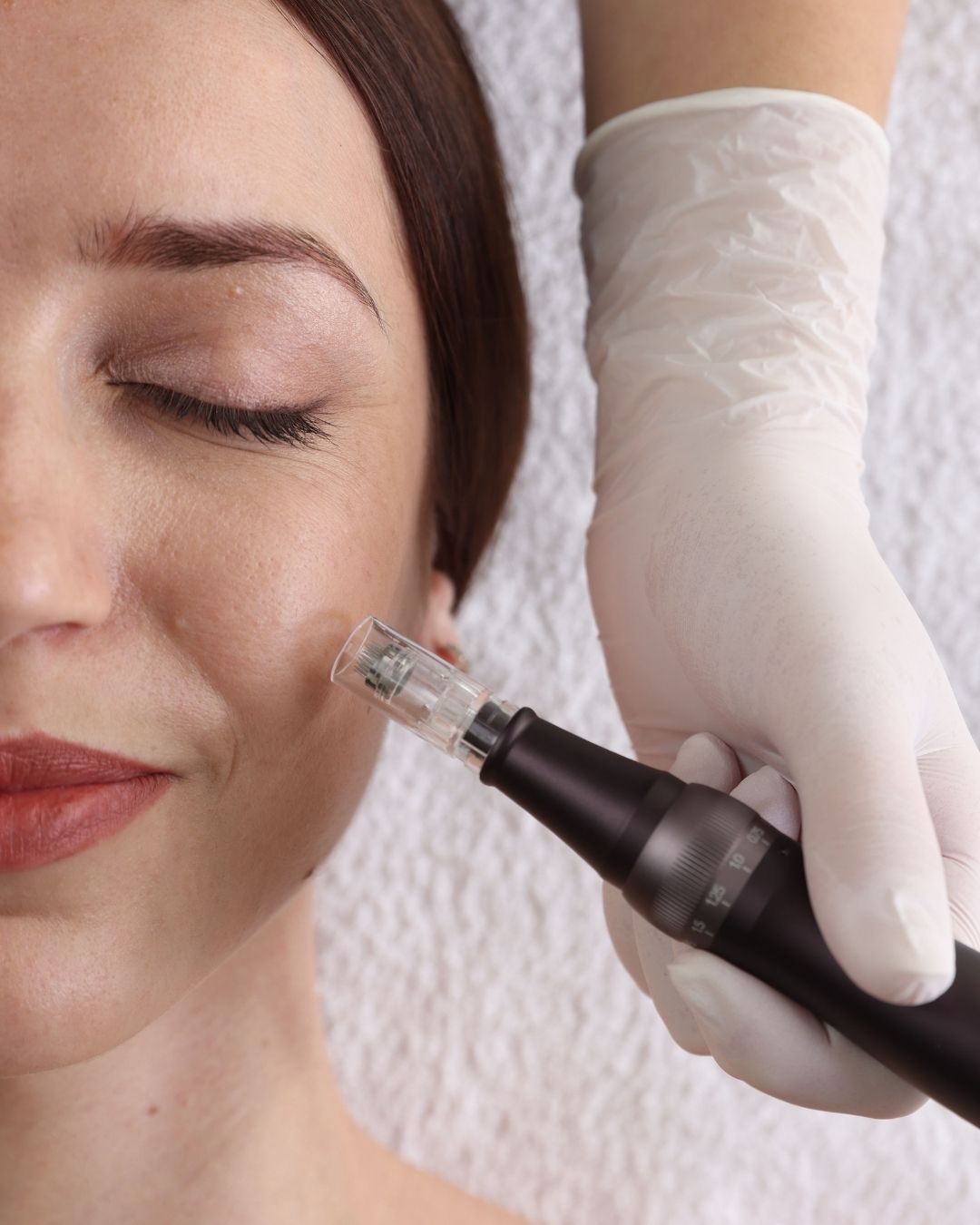 Microneedling Treatment